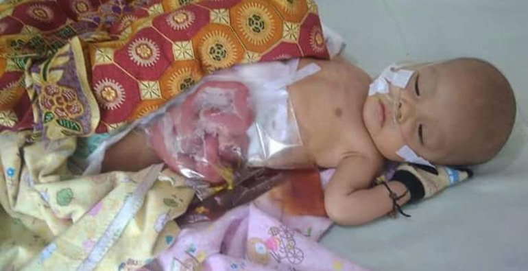 Bayi Tak Dapat Buang Air Besar dan Air Kecil Butuh Bantuan