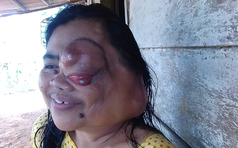 Sunarmi Butuh Perhatian dan Uluran Tangan Dermawan