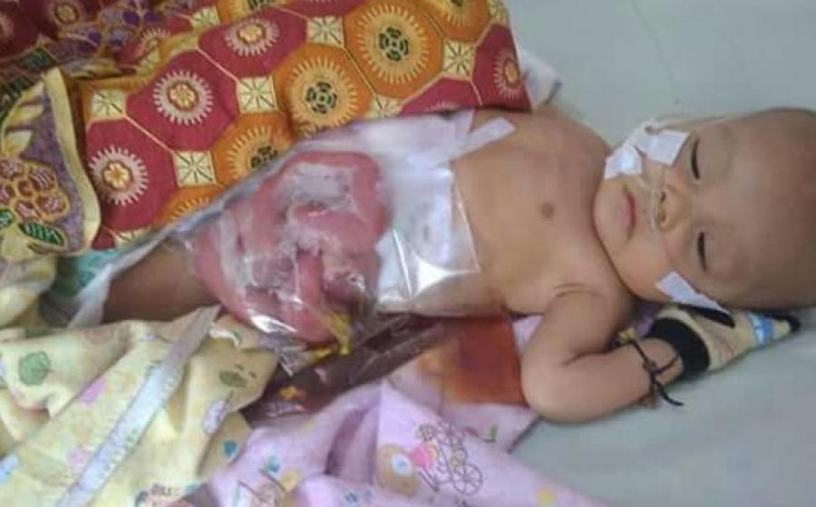 Bayi Tak Dapat Buang Air Besar dan Air Kecil Butuh Bantuan
