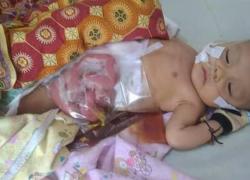 Bayi Tak Dapat Buang Air Besar dan Air Kecil Butuh Bantuan